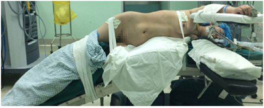 机器人辅助后腹腔镜肾部分切除术(附21例报道)