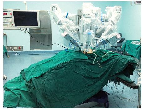 机器人辅助腹腔镜肾盂输尿管离断成形术的初步经验(附21例报告)